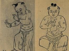 1000: First Chinese Inoculation