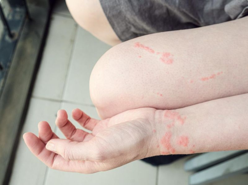 An allergic reaction on the skin from contact with a jellyfish